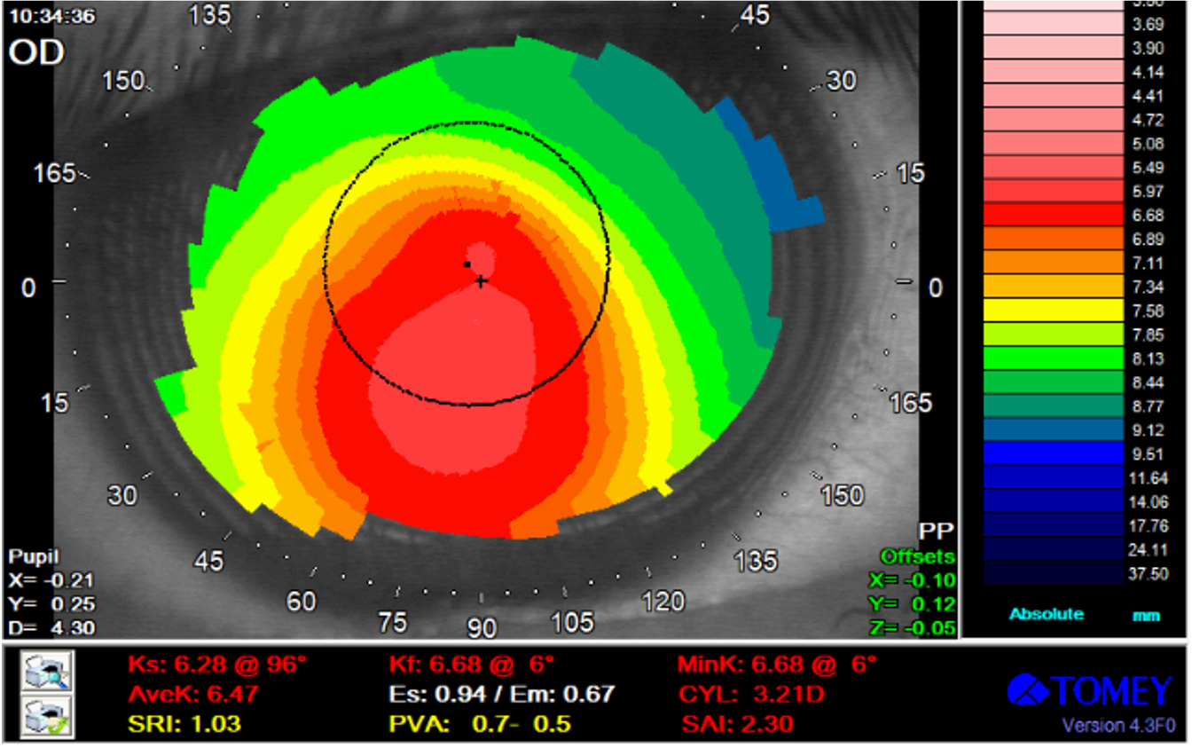 The relationship between Meibomian Gland Dysfunction and Keratoconus ...