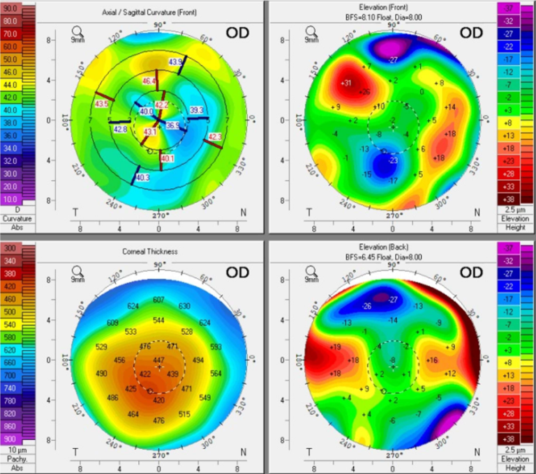 Reclaiming Vision: Scleral Lens Fitting After Acanthamoeba Infection ...